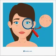 milium, میلیا، کیست میلیوم (برجستگی سفید پوستی ریز)